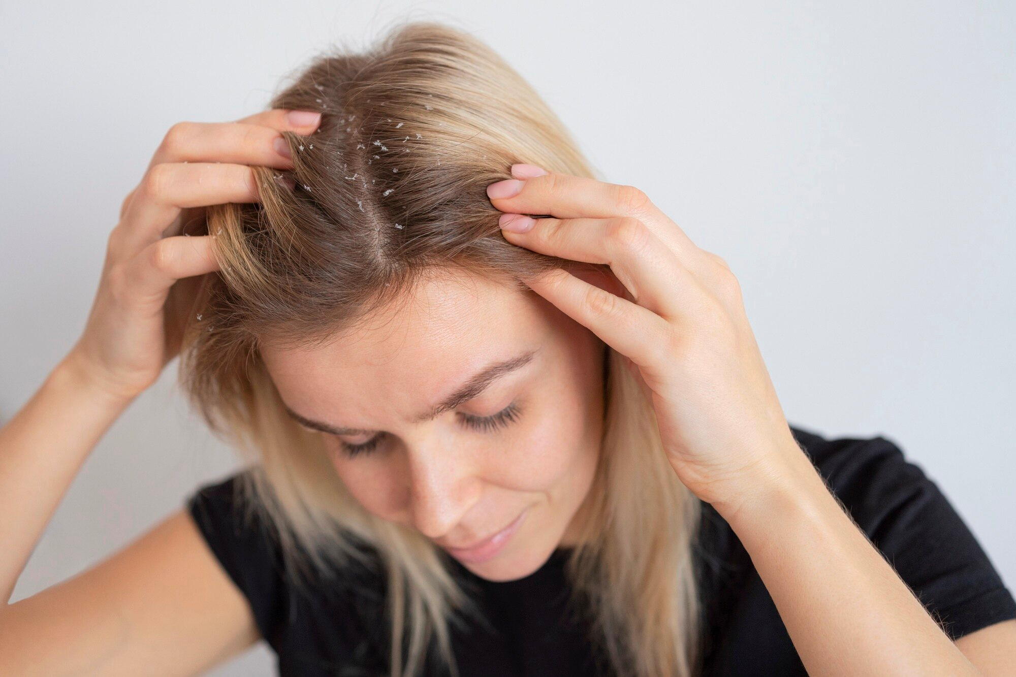 Dry Flaky Scalp Treatment