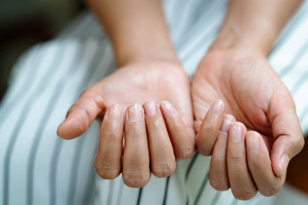 Brittle Nails Treatment