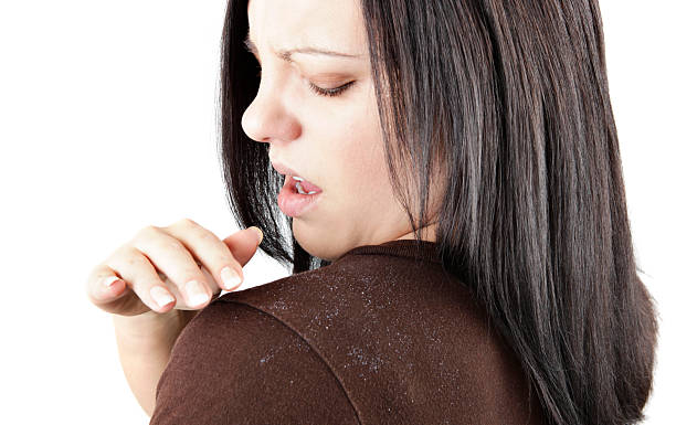 Dandruff Treatment at Home