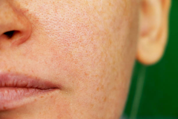 How To Get Rid of Open Pores?