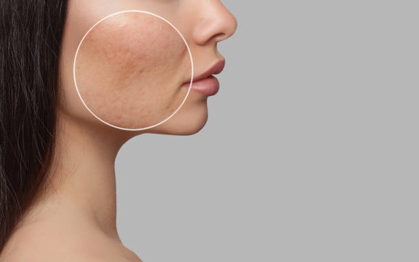 Facial Discoloration in Women
