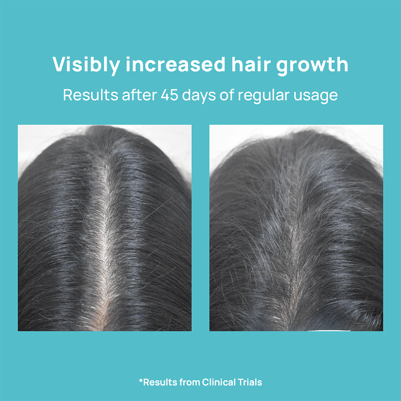 Amazon.com: FoliGROWTH™ Hair Growth Supplement for Thicker Fuller Hair |  Approved* by the American Hair Loss Association | Revitalize Thinning Hair,  Backed by 20 Years of Experience in Hair Loss Treatment Clinics :